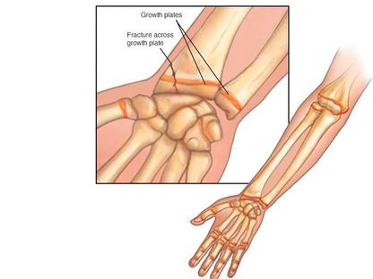 إذا مرّ كسر خلال صَفيحة النمو الموجودة عند نهايات العظم لدى الطفل فقد يؤدي ذلك إلى قِصَر الطرف أو اعوجاجه - Mayo Clinic