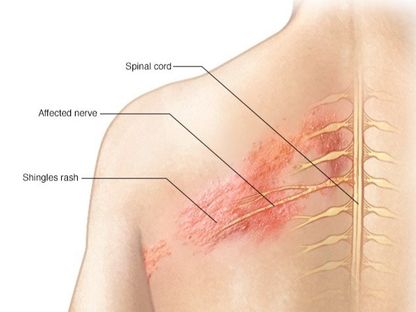 يؤثر الهربس النطاقي في الأعصاب - www.mayoclinic.org