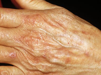يد شخص مصاب بمرض البرفيريا الجلدية. 6 أغسطس 2002 - AFP
