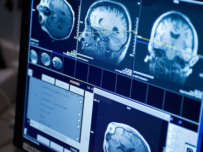 تصوير بالرنين المغناطيسي لورم في الدماغ - Mayo Clinic