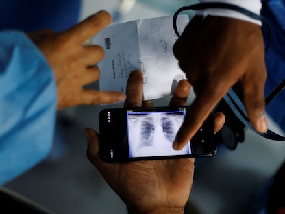 أشعة صدر لأحد المرضى في العاصمة الفنزولية كاراكاس . 21 مارس 2021 - REUTERS