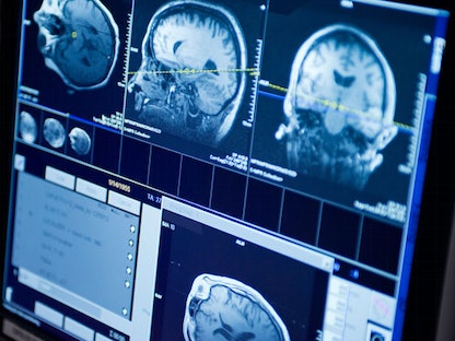 تصوير الدماغ بالرنين المغناطيسي - Mayo Clinic