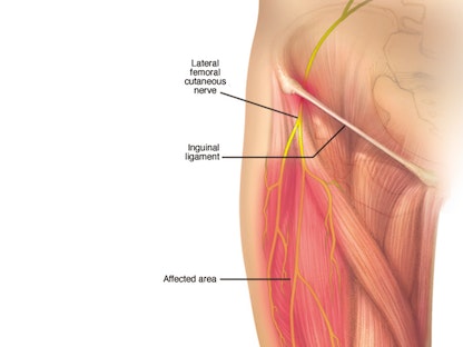 ألم الفخذ المذلي يحدث عند انضغاط العصب الجلدي الفخذي الوحشي الذي يغذي إحساس الجزء الخارجي للفخذ - Mayo clinic