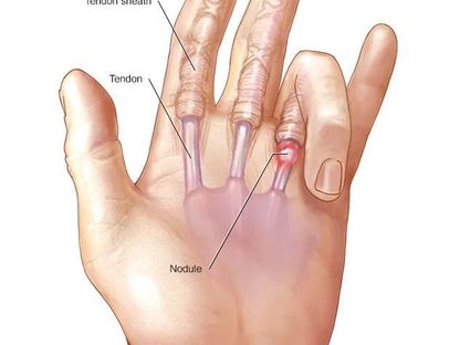صورة مقطعية تُظهر حالة الإصبع الزنادي في اليد - - مايو كلينك