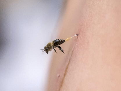 نحلة تلسع ظهر مريض بعيادة للعلاج بلسعات النحل في مصر. يونيو 2021 - Khaled DESOUKI