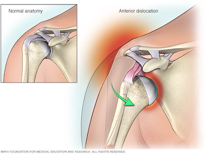 إصابة خلع الكتف - مايو كلينيك