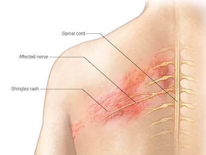 صورة توضيحية تُظهر منطقة مصابة بالهربس النطاقي على الأعصاب في جذع الإنسان - مايو كلينيك