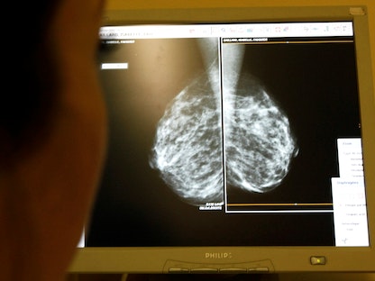 صورة بالأشعة السينية لصدر شخص للكشف عن وجود أورام في عيادة بمدينة نيس الفرنسية - REUTERS