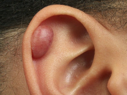مريضة تعاني من ظهور ندبة الجدرة في الأذن.  - BSIP