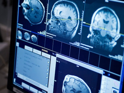 تصوير بتقنية الرنين المغناطيسي يظهر الدماغ من جهات مختلفة - Mayo Clinic