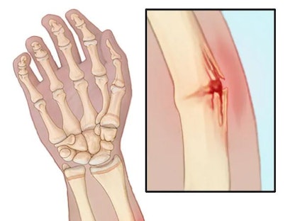 صورة توضح حدوث تشققات بالعظام - Mayo Clinic