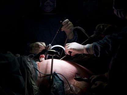 عملية جراحة تكميم المعدة لإنقاص الوزن في مستشفى بفرنسا  - Universal Images Group via Getty