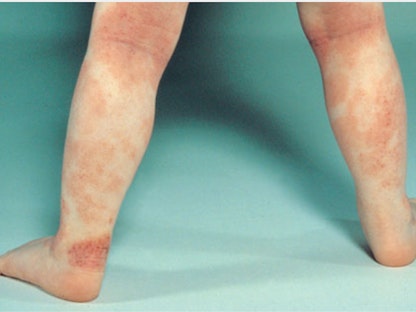 عادةً ما يظهر التهاب الجلد التأتبي (إكزيما الأطفال) على شكل بقع حمراء وحكة - Mayo clinc