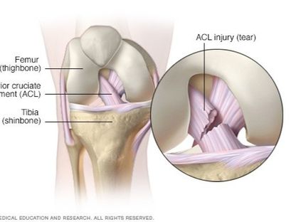 الرباط التصالبي الأمامي هو أحد الأربطة الأساسية التي تساعد على توازن مفصل الركبة ويصل بين عظم الفخذ وقصبة الساق. - مايو كلينك