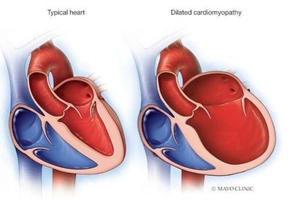 اعتلال عضلة القلب التوسعي يؤدي إلى زيادة حجم غرف القلب - www.mayoclinic.org