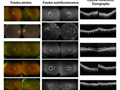تظهر الصور الطبية للعين لدى خمسة من المرضى المشاركين في الدراسة تبايناً كبيراً في أشكال ضمور الشبكية - Bin Guan, Ph.D.