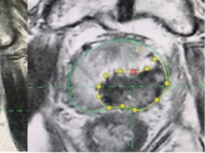 باحثون: نتائج سريرية واعدة لجهاز يعالج سرطان البروستاتا بالليزر