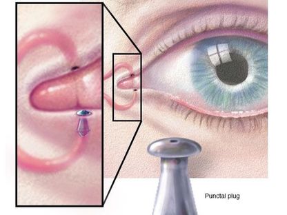 رسم توضيحي لإحدى علاجات القناة الدمعية في العين. - مايو كلينك