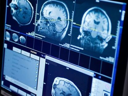 تصوير بتقنية الرنين المغناطيسي يظهر الدماغ من جهات مختلفة - Mayo Clinic