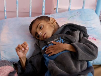 طفل فلسطين يعاني الجوع يرقد على سرير مستشفى ناصر  في خان يونس جنوب قطاع غزة. 1 مايو 2025 - Reuters