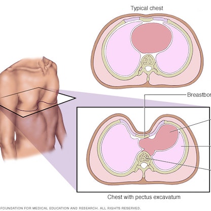 "تقعر القفص الصدري".. حالة وراثية علاجها الجراحة