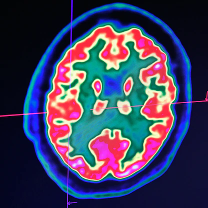 دراسة: وسائل التواصل الاجتماعي تُغير أدمغة المراهقين