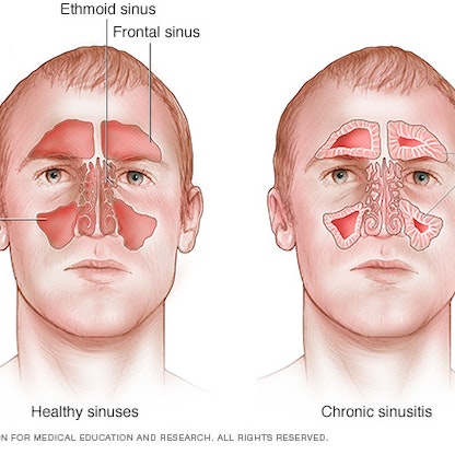 التهاب الجيوب الأنفية المزمن.. الأسباب وطرق العلاج