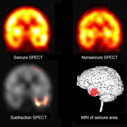 دراسة: مرضى الصرع في إنجلترا لا يحصلون على رعاية متساوية
