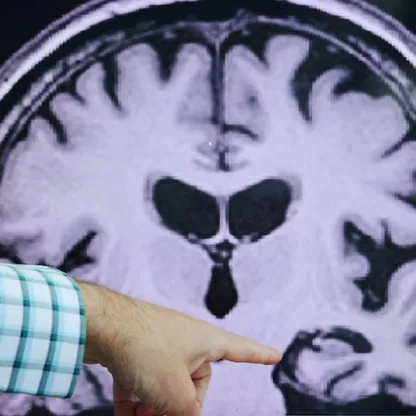 دراسة: التغيرات الدماغية في مرض ألزهايمر تختلف بين الرجال والنساء