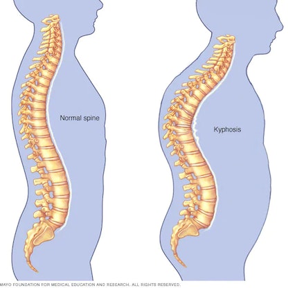 تقوس الظهر.. الأسباب والمضاعفات