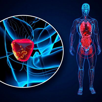 باحثون يبتكرون طريقة جديدة لعلاج سرطان البروستاتا العدواني