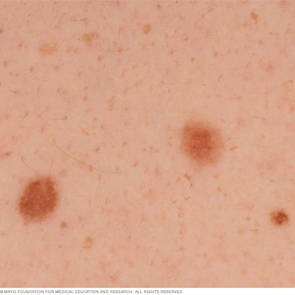 هل هناك علاقة بين الشامات الجلدية والسرطان؟