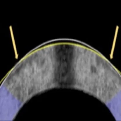 بديل لعمليات الليزك.. تصحيح الإبصار بالتيار الكهربائي