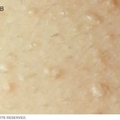 الطفح الجلدي المزمن.. بقع مزعجة قد تعوق الحياة اليومية