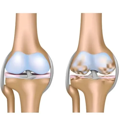 طريقة جديدة لعلاج آلام الركبة الشائعة