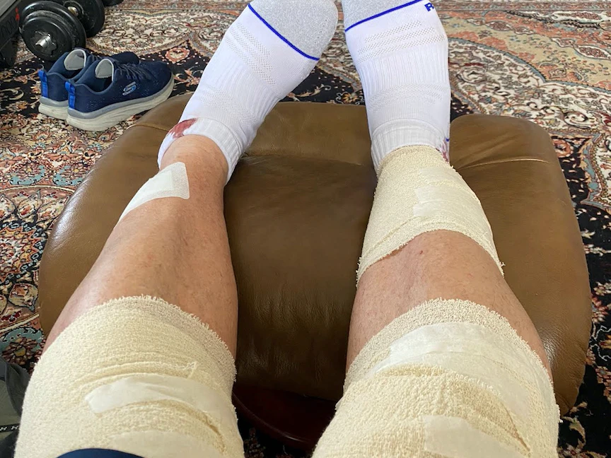 شاب بريطاني يعاني من تورم ساقي - REUTERS