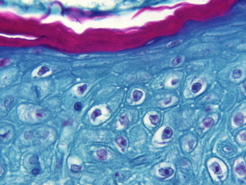 "جدري القرود" يصل 3 قارات ويسجل عشرات الإصابات