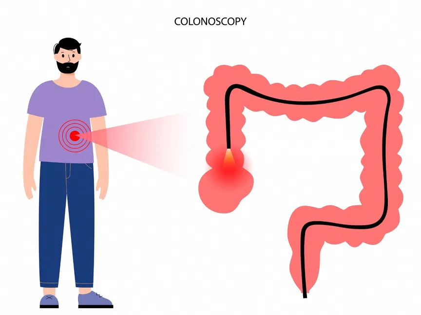 صورة توضيحية للفحص عن طريق تنظير القولون. 8 يونيو 2022 - AFP
