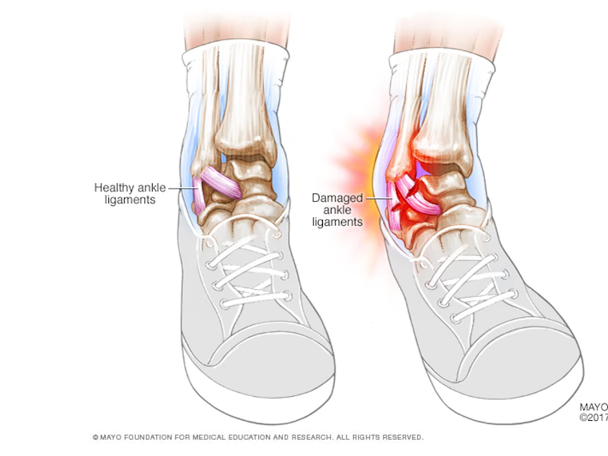 التواء الكاحل هو شد في أربطته أو تمزقها ما يؤثر على دعم المفصل عن طريق ربط العظام ببعضها