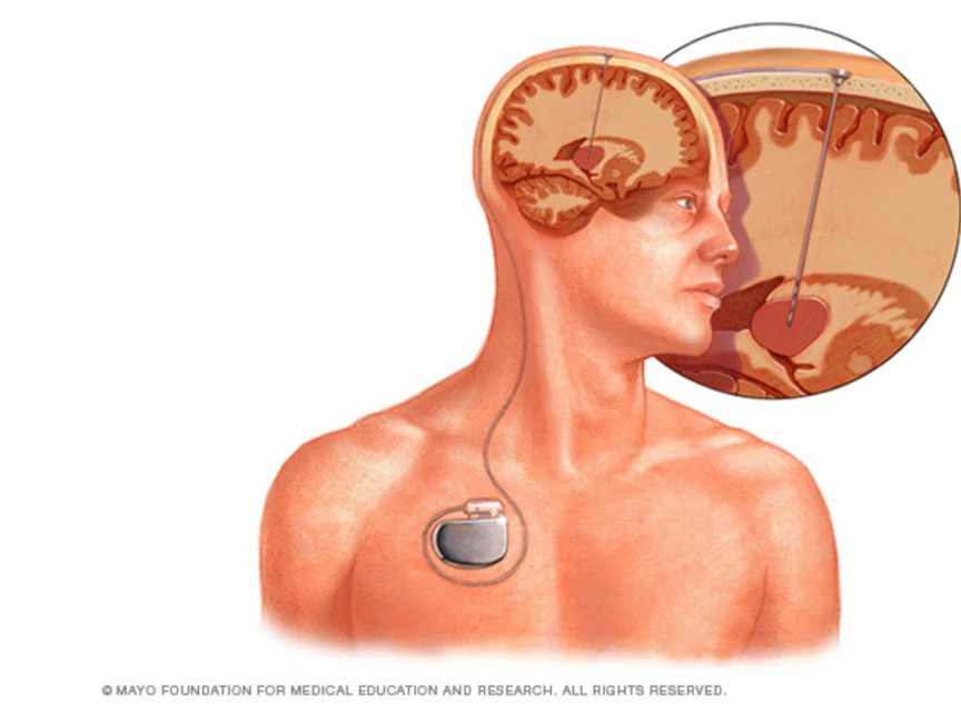 ينطوي التحفيز العميق للدماغ على زرع قطب كهربائي بصورة عميقة داخله يتم توصيله بالقلب - مايوكلينيك