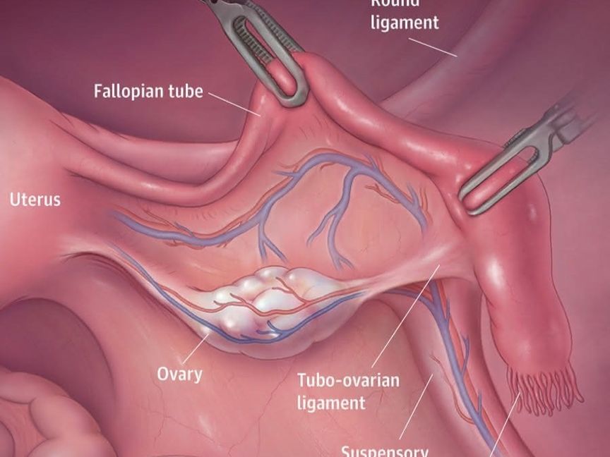 دراسة: الاستئصال الوقائي لقناة فالوب يقلل خطر الإصابة بسرطان المبيض