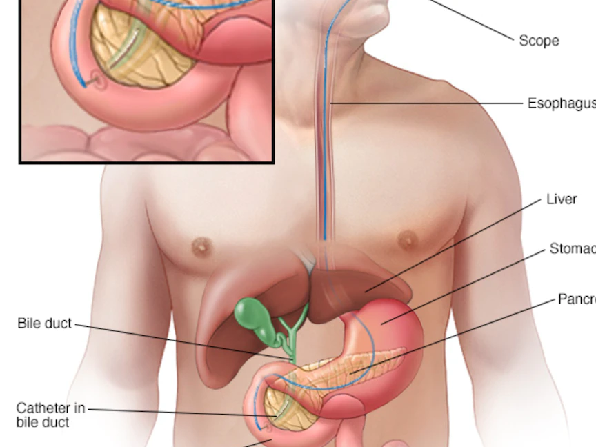 يستخدم تصوير البنكرياس والقنوات الصفراوية بالمنظار صبغة لتمييز القنوات الصفراوية في صور الأشعة السينية كإحدى طرق العلاج - Mayo Clinic