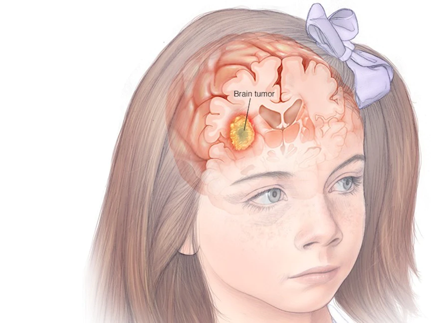 الورم في خلايا الدماغ يسبب ضغطاً على الأنسجة المجاورة ويغيّر وظيفتها، ما يؤدي إلى ظهور أعراض مثل الصداع والغثيان ومشكلات في التوازن - Mayo Clinic