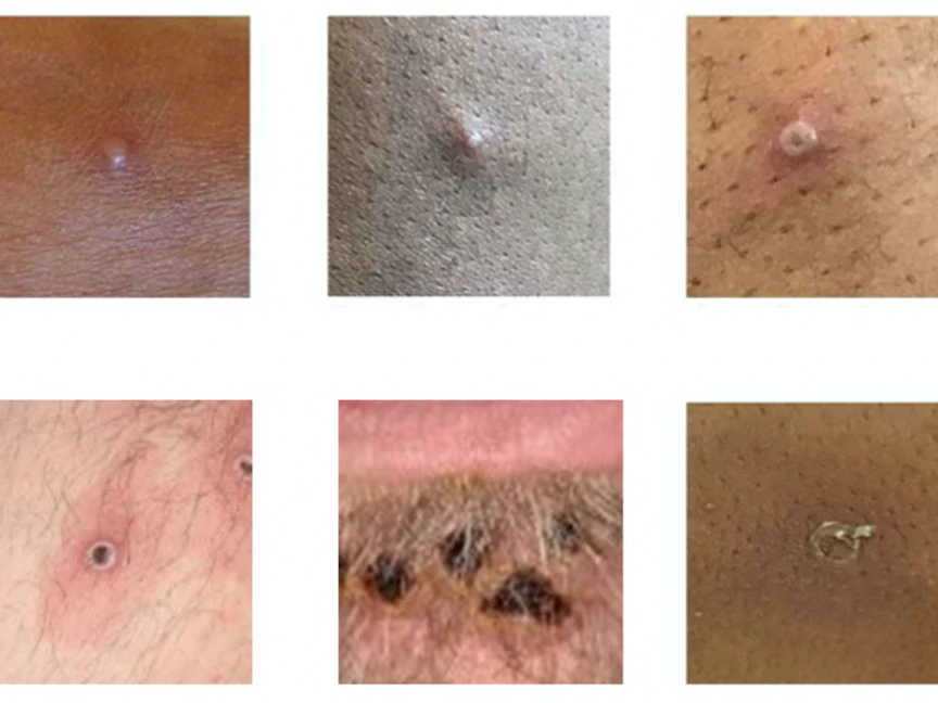 طفح جلدي وآفات ناجمة عن فيروس جدري القرود. - REUTERS