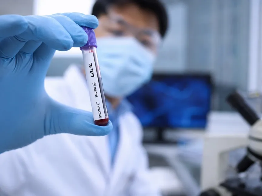 اختبار دم قد يسرع من تشخيص مرض السل ويحد من انتقال العدوى