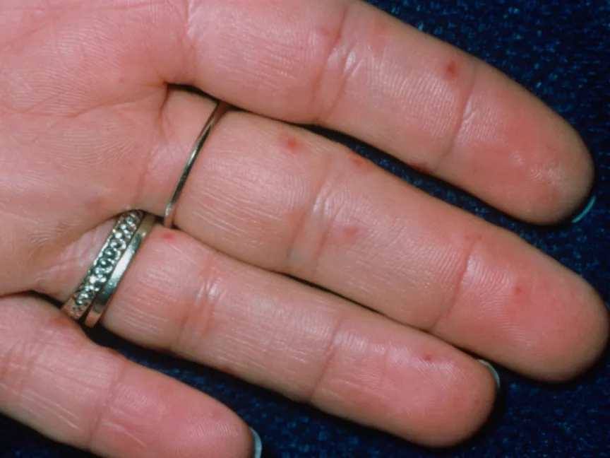 يد مريضة مصابة بتورم الأطراف. 16 يناير 2003 - AFP