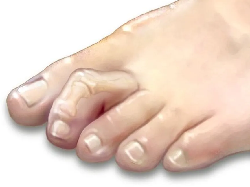 كسر إصبع القدم.. 4 طرق للعلاج و6 أسابيع للتعافي