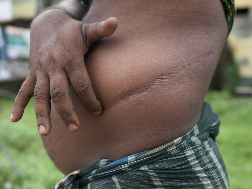 فنزويلا.. توقيف امرأة عرضت بيع كلية فتاة عبر الإنترنت