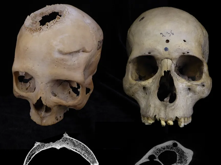 صورة تظهر آثار أورام سرطانية في جمجمة مومياء مصرية. - Frontiers in Medicine