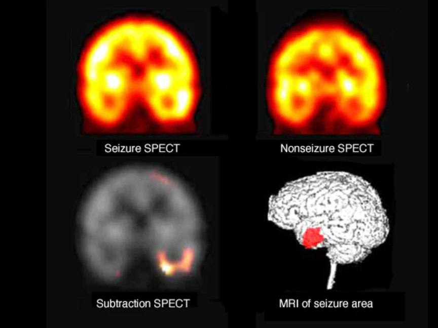فحص بالتصوير المقطعي المحوسب بإصدار فوتون واحد أُجري أثناء نوبات الصرع وفيما بينها - "مايو كلينيك"